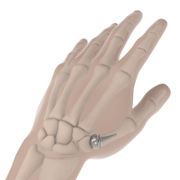 BioPro® Modular Thumb Implant