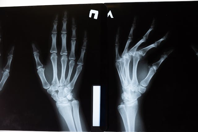 Hand Anatomy X ray Finger Injuries treatment nyc