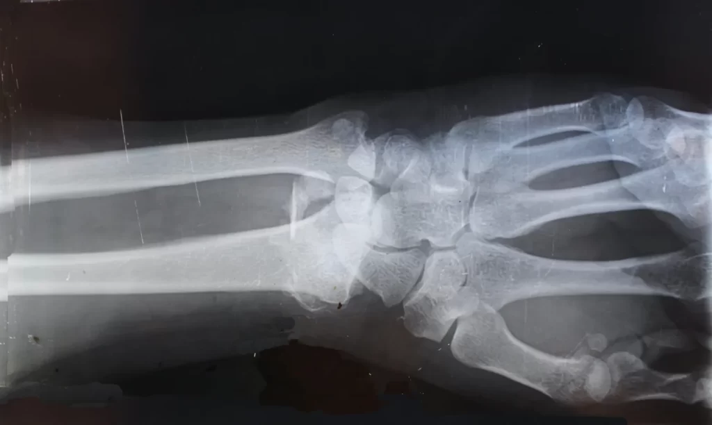 X-ray-wrist-bones-Wrist Injury Sprained or Broken